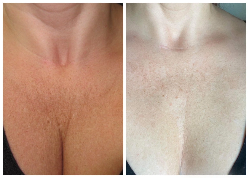 Microbotox(neck:chest)