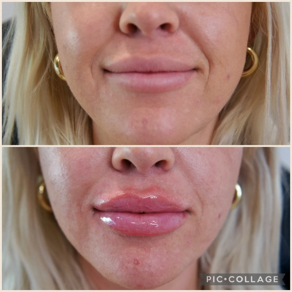 Lip flip before and after results