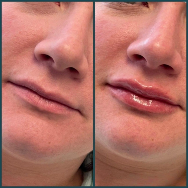 Juvederm dermal fillers before and after images