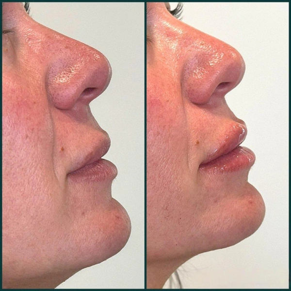 Restylane facial fillers before and after results