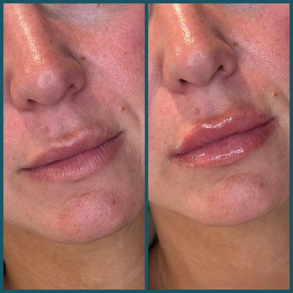 Restylane facial fillers before and after results