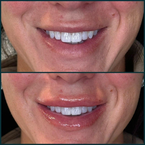 Restylane facial fillers before and after results