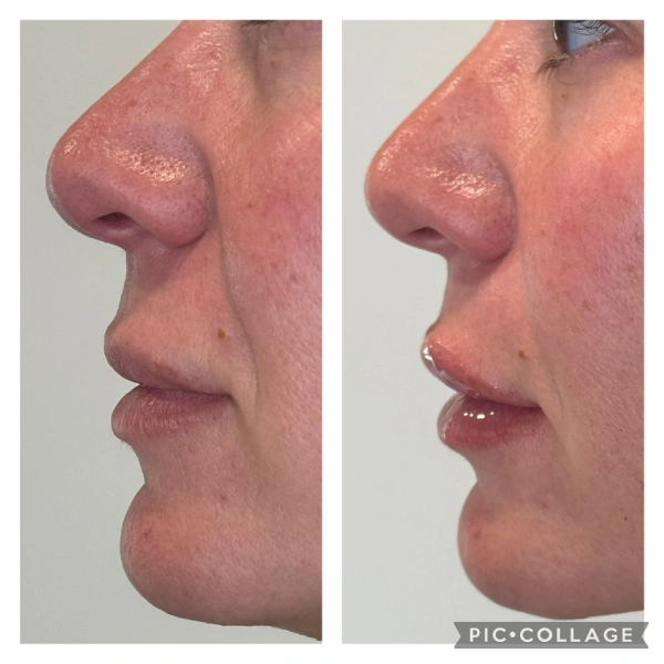 Restylane facial fillers before and after results