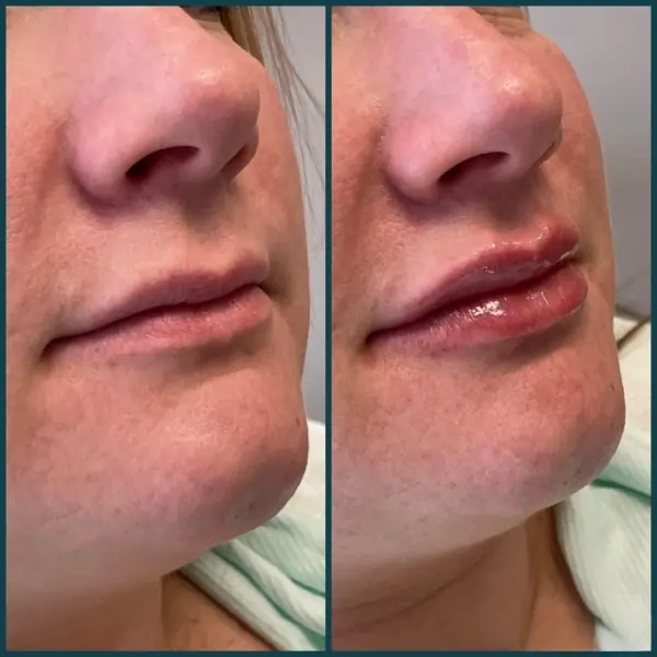 Juvederm Ultra lip filler before and after results at The Confidence Collective