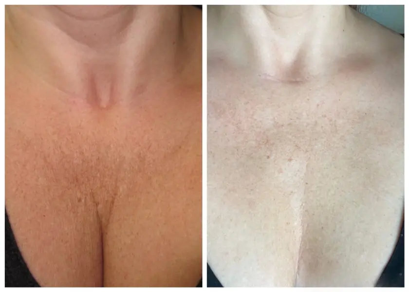 MicroBotox neck and chest before and after skin smoothing results