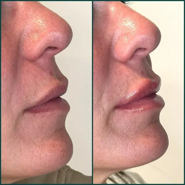 Restylane Kysse lip filler before and after side profile results