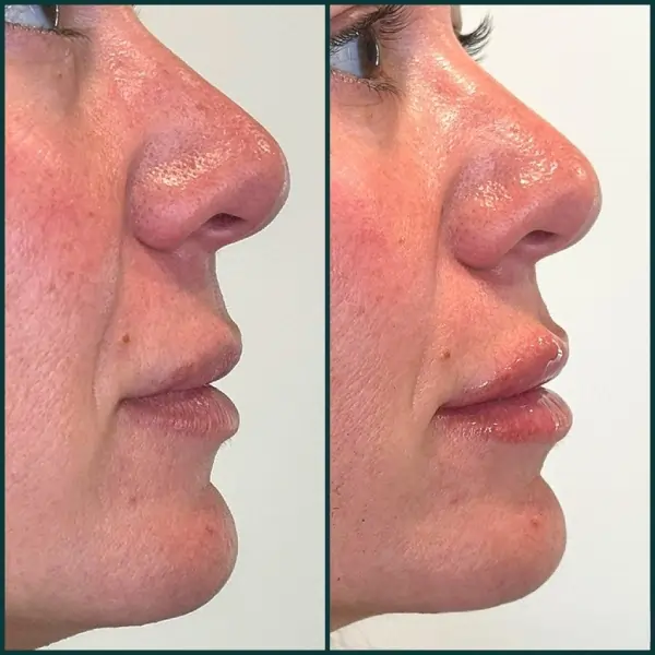 Side profile before and after Restylane Kysse lip enhancement