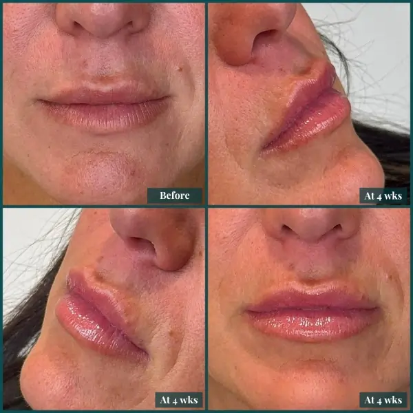 Restylane Kysse lip filler before and after results at The Confidence Collective