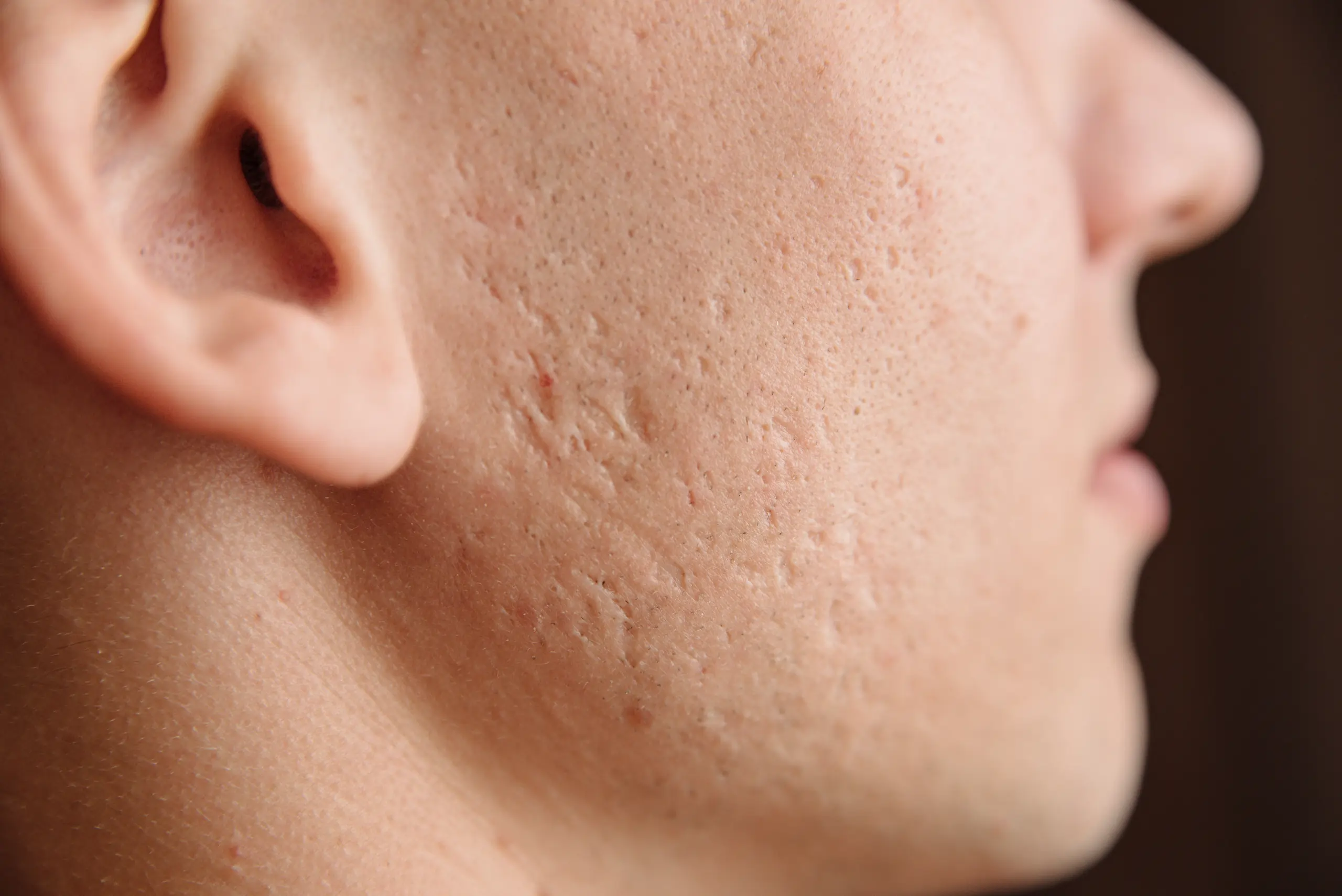 Acne scar correction for smoother skin at The Confidence Collective in Sioux Falls, SD.