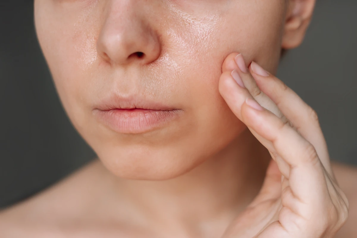 Close-up of uneven oily skin with visible large pores before MicroBotox skin texture treatment