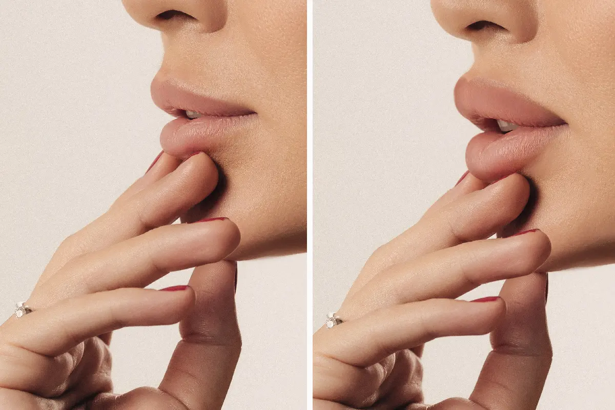 Woman showing her lips to illustrate lip flip and lip filler treatments for fuller, more defined lips