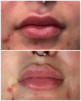 Restylane facial fillers before and after results