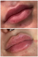 Restylane facial fillers before and after results