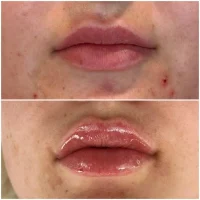 Restylane facial fillers before and after results