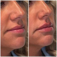 Dermal filler before and after results