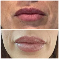 Restylane facial fillers before and after results