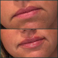 Dermal filler before and after results