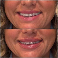Dermal filler before and after results