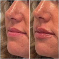 Dermal filler before and after results