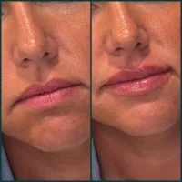 Dermal filler before and after results