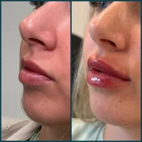 Dermal filler before and after results