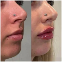 Dermal filler before and after results