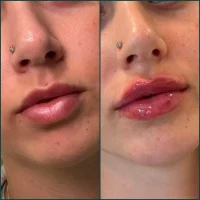 Dermal filler before and after results