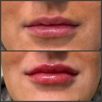 Dermal filler before and after results