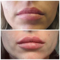 Dermal filler before and after results