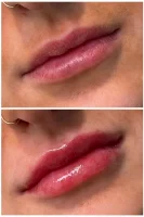 Dermal filler before and after results