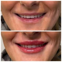 Dermal filler before and after results