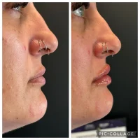 Dermal filler before and after results