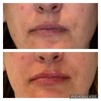 Dermal filler before and after results