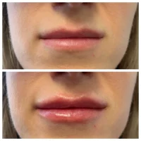 Dermal filler before and after results