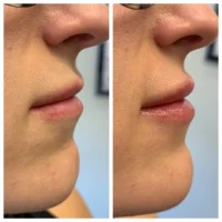 Dermal filler before and after results