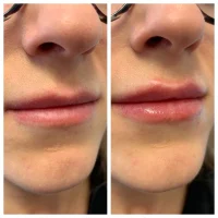 Dermal filler before and after results