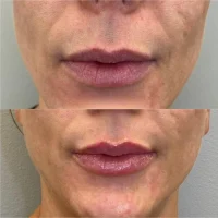 Dermal filler before and after results