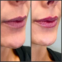Dermal filler before and after results