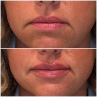 Dermal filler before and after results