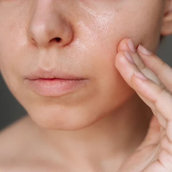 Close-up of uneven oily skin with visible large pores before MicroBotox skin texture treatment